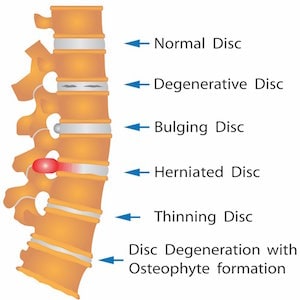 Back Injury