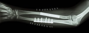 Broken bone